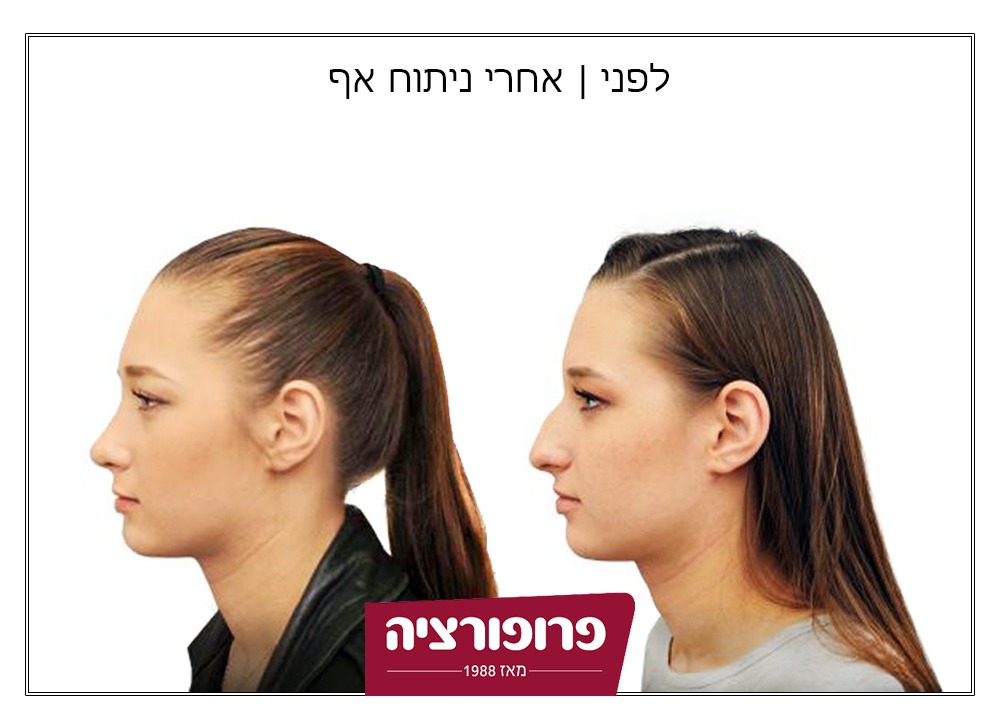 לפני ואחרי ניתוח אף | רשת מרפאות פרופורציה