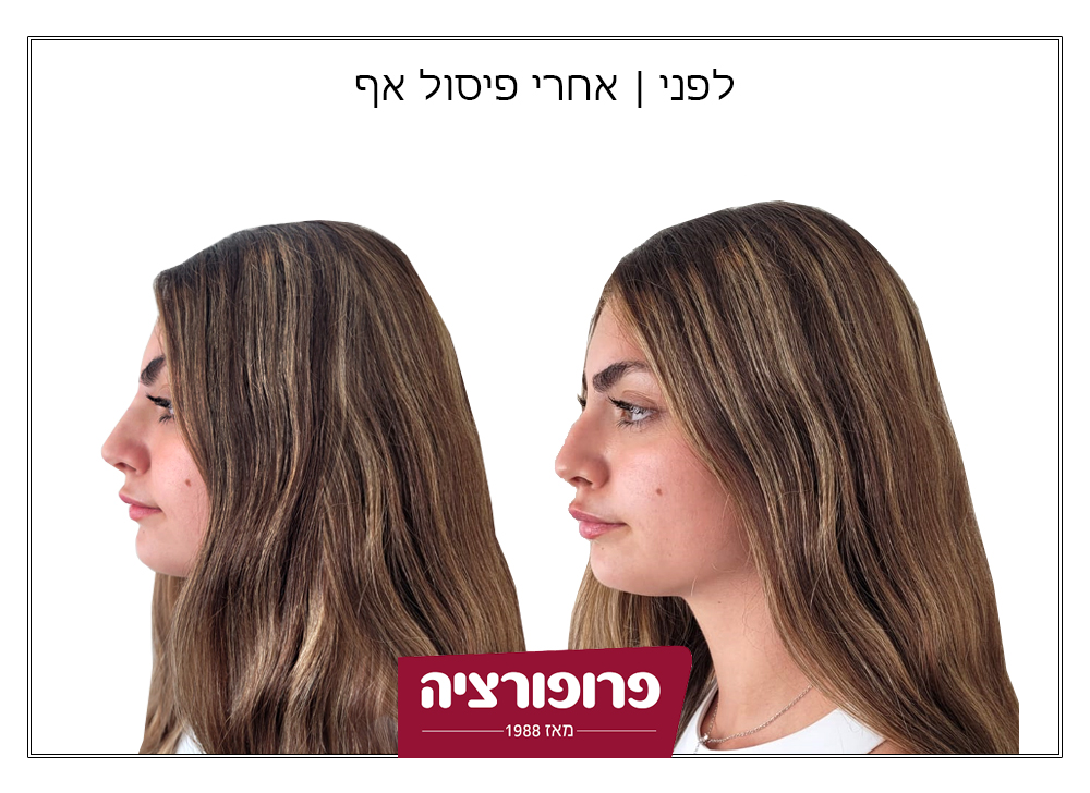 לפני ואחרי פיסול אף | רשת מרפאות פרופורציה