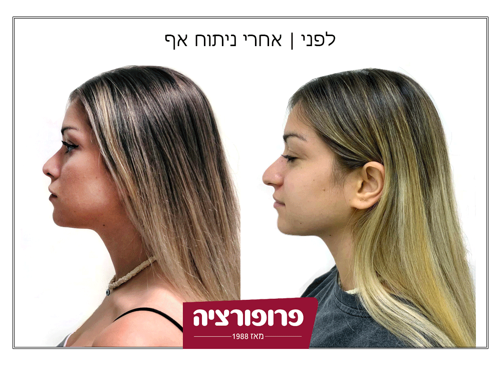 לפני ואחרי ניתוח אף | רשת מרפאות פרופורציה