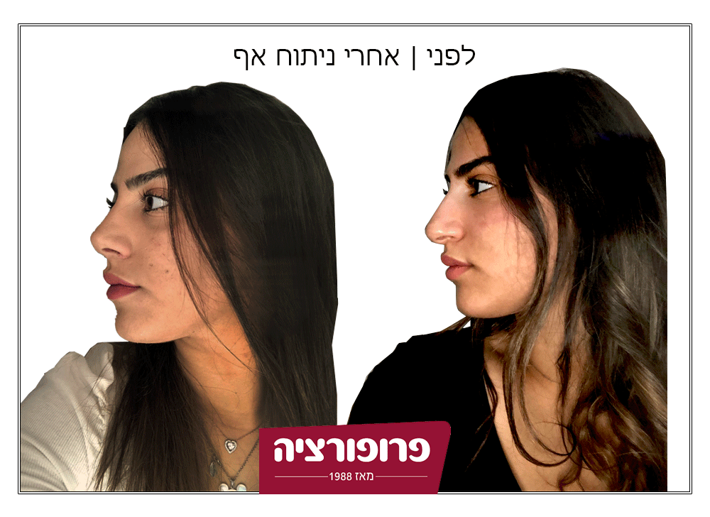 לפני ואחרי ניתוח אף | רשת מרפאות פרופורציה