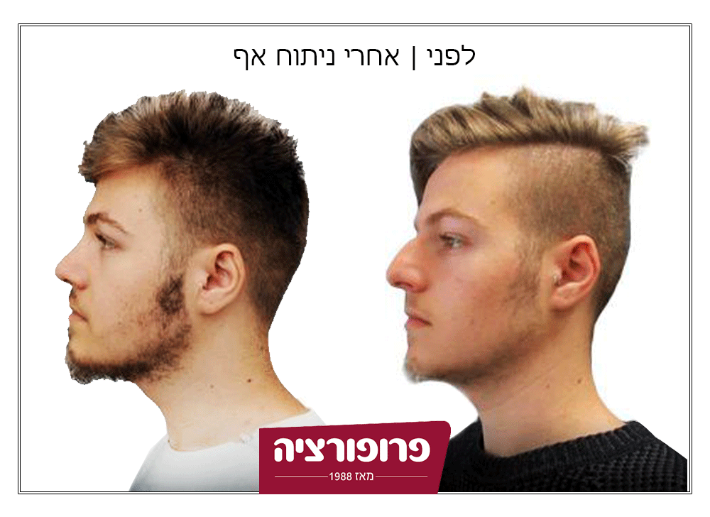 לפני ואחרי ניתוח אף | רשת מרפאות פרופורציה