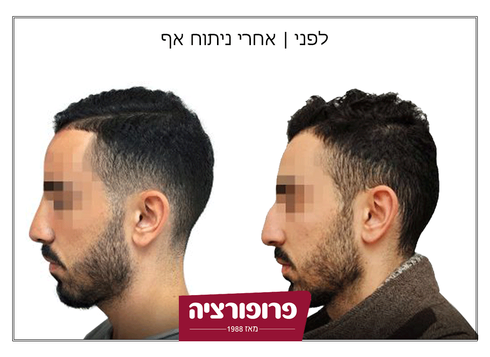 לפני ואחרי ניתוח אף | רשת מרפאות פרופורציה